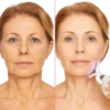 جوانسازی پوست صورت در منزل با دستگاه لیفتینگ صورت؛ 1واقعیت علمی، مزایا، معایب و بهترین انتخاب