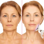 جوانسازی پوست صورت در منزل با دستگاه لیفتینگ صورت؛ 1واقعیت علمی، مزایا، معایب و بهترین انتخاب