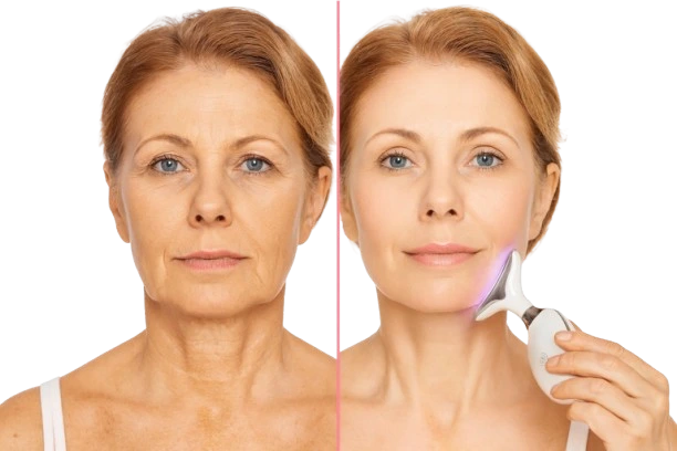 جوانسازی پوست صورت در منزل با دستگاه لیفتینگ صورت؛ 1واقعیت علمی، مزایا، معایب و بهترین انتخاب